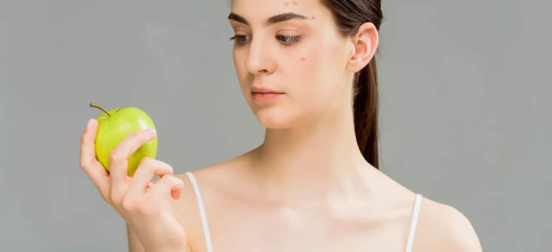 Co jeść na cerę trądzikową, aby skutecznie walczyć z problemami skórnymi